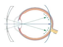 SEHHAUS myopie managment glaeser kontaktlinsen transparent uai