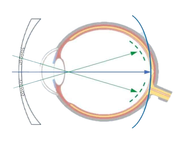 SEHHAUS myopie managment glaeser kontaktlinsen transparent