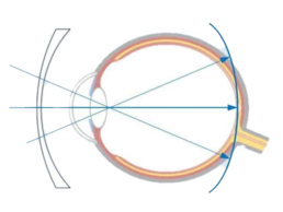 SEHHAUS myopie managment mit brille kontaktlinsen transparent uai