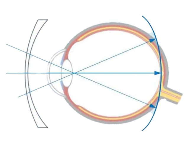 SEHHAUS myopie managment mit brille kontaktlinsen transparent