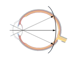 SEHHAUS myopie managment ohne brille kontaktlinsen transparent uai