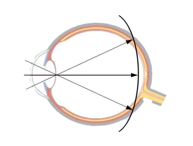 SEHHAUS myopie managment ohne brille kontaktlinsen transparent